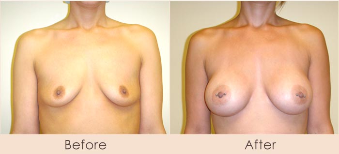 Silicone Breast Augmentation Under Muscle Inframammary Incision 325cc