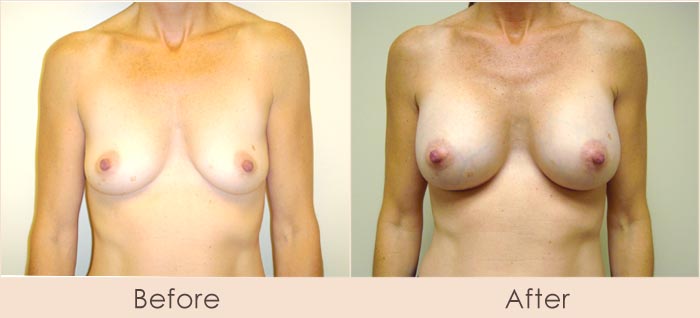 Silicone Breast Augmentation Under Muscle Inframammary Incision 325cc 