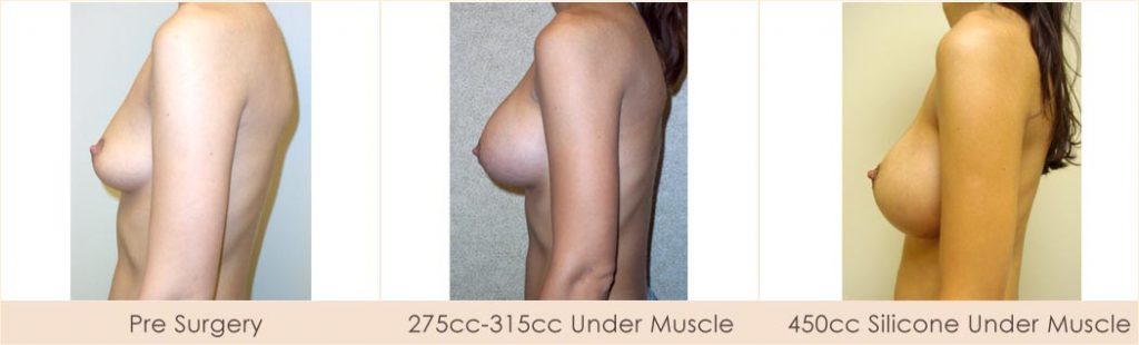 Breast Implant Removal and Enlargement