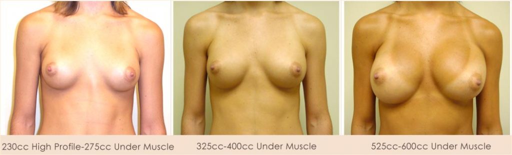 Breast Implant Removal and Enlargement