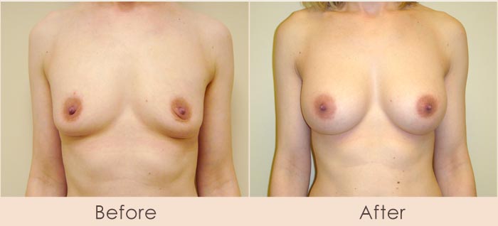 Silicone Breast Augmentation Under Muscle Inframammary Incision 300cc 