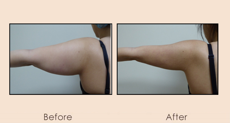 External Ultrasonic Liposuction and Smart MPX of Arms and Side of Arms