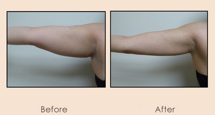 External Ultrasonic Liposuction and Smart MPX of Arms and Side of Arms
