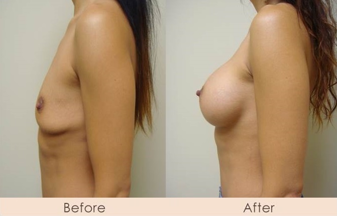 Silicone Breast Augmentation Under Muscle Inframammary Incision 400cc 