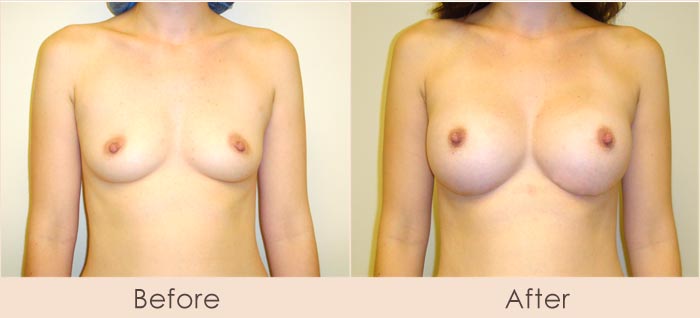 Silicone Breast Augmentation Under Muscle Inframammary Incision L300cc – R325cc 