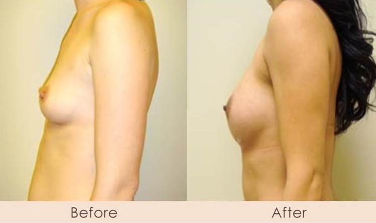 Silicone Breast Augmentation Under Muscle Inframammary Incision L300cc – R325cc