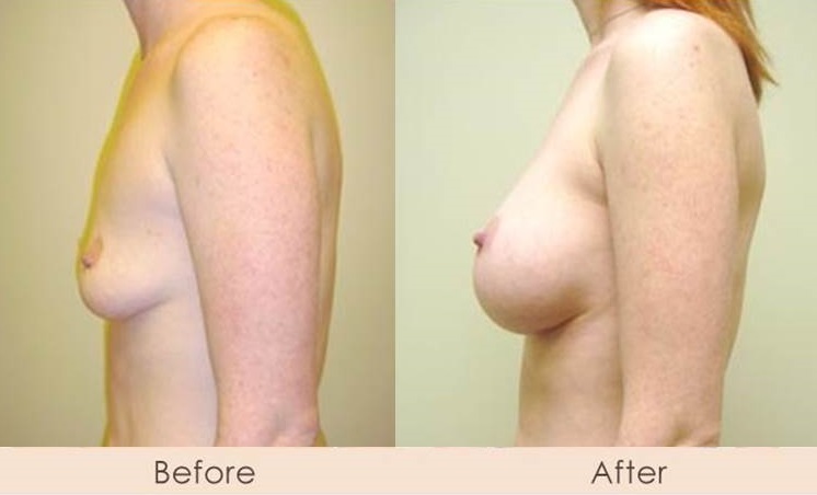 Silicone Breast Augmentation Under Muscle Inframammary Incision 350cc 