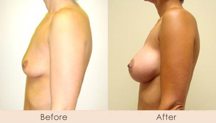 Silicone Breast Augmentation Under Muscle Inframammary Incision 325cc