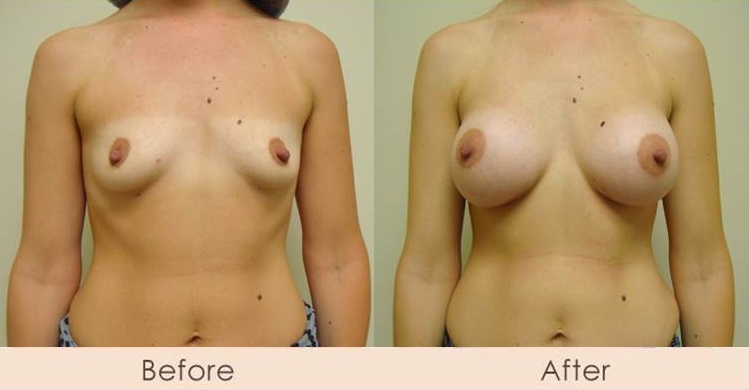Silicone Breast Augmentation Under Muscle Inframammary Incision 350cc
