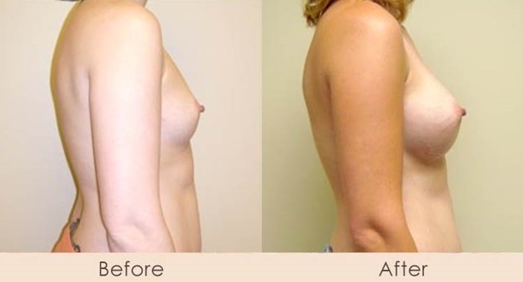 Silicone Breast Augmentation Under Muscle Inframammary Incision 375cc