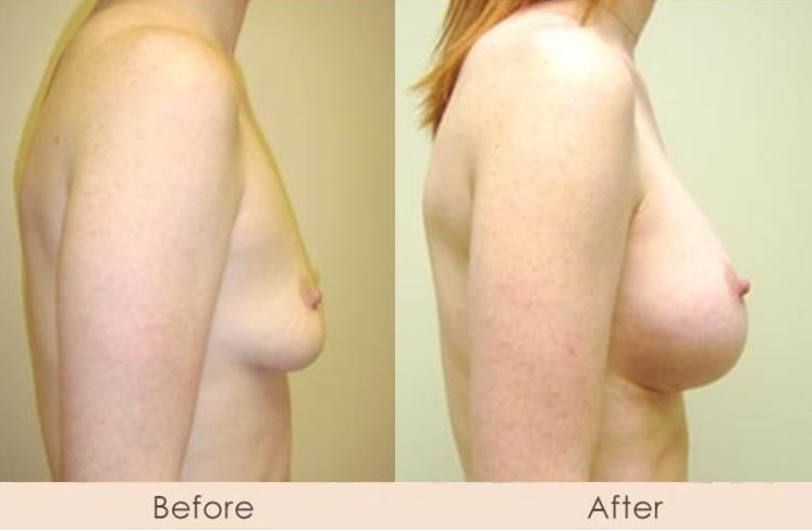 Silicone Breast Augmentation Under Muscle Inframammary Incision 350cc 