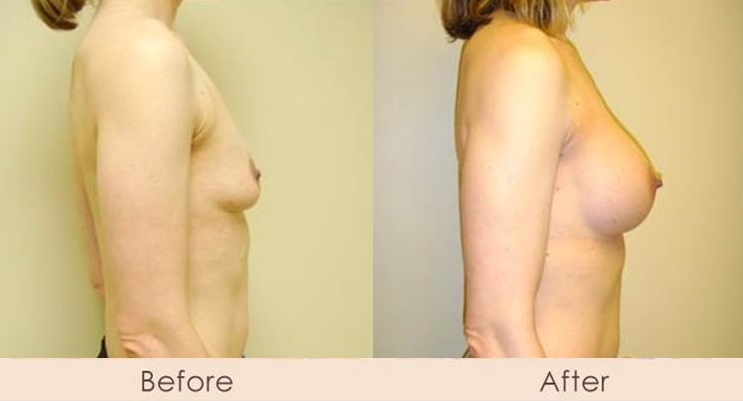 Silicone Breast Augmentation Under Muscle Inframammary Incision 300cc 