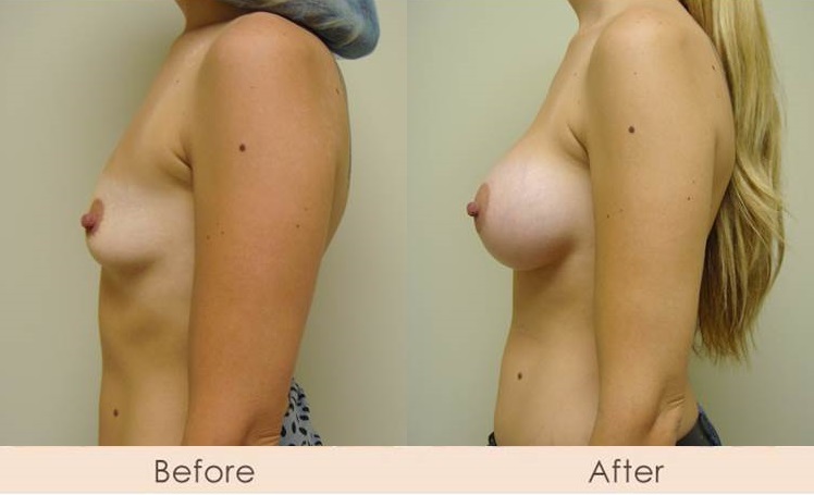 Silicone Breast Augmentation Under Muscle Inframammary Incision 350cc