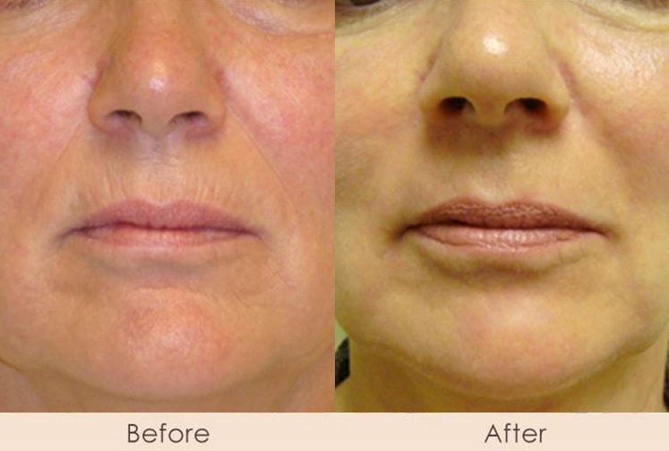 Alloderm Nasal Folds and Marionettes