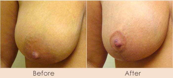 Areola Reduction w/ Breast Lift