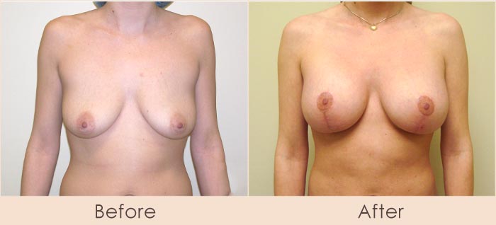 Breast Lift with Scarless Breast Implants, 275cc – 315cc Under Muscle