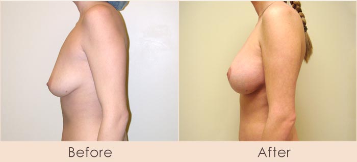 Breast Lift with Scarless Breast Implants, 275cc – 315cc Under Muscle