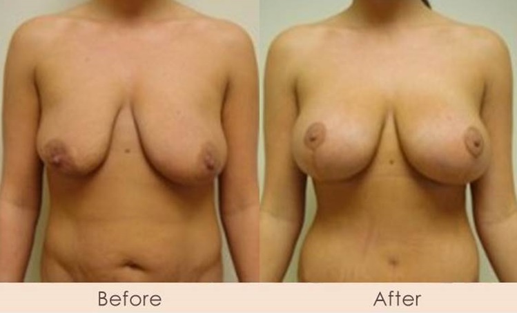 Breast Lift with Breast Implants