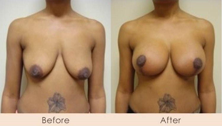 Breast Lift with Scarless Breast Implants, Left 325 – 325cc Right 325 – 400cc