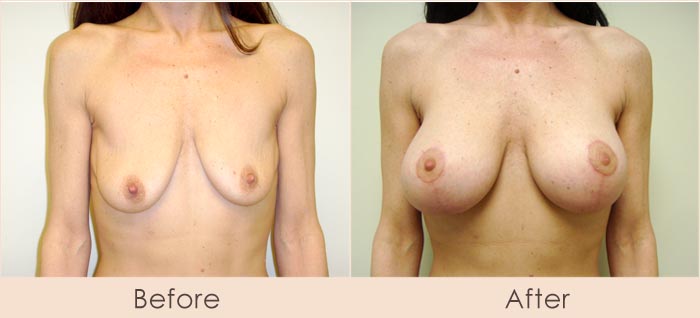 Breast Lift with Silicone Breast Implants, 300cc Smooth Under Muscle