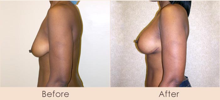 Breast Lift with Scarless Breast Implants, 225cc – 265cc Under Muscle