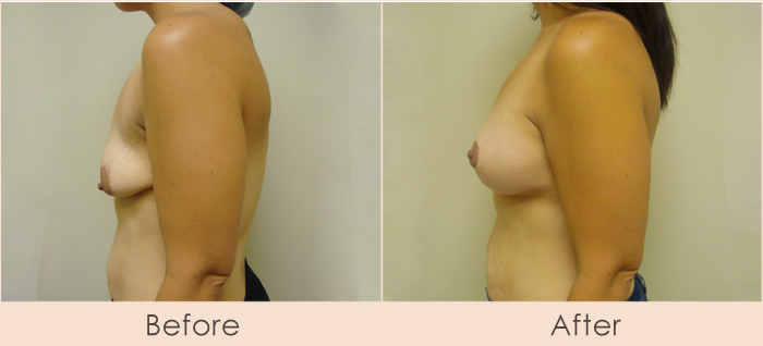 Breast Lift with Saline Breast Implants, 250cc – 290cc Under Muscle