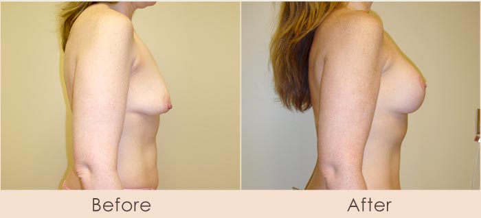 Breast Lift with Scarless Breast Implants, Left: 175cc – 215cc, Right: 200cc – 240cc Under Muscle