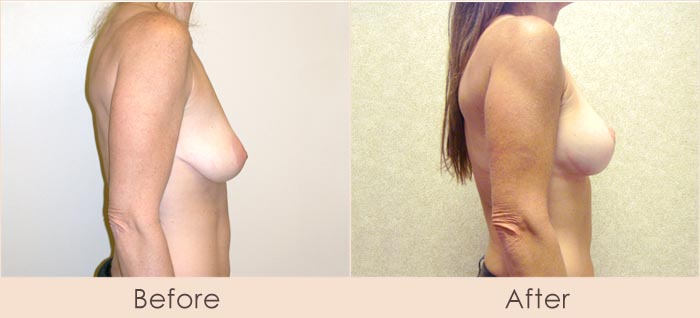 Breast Lift with Silicone Breast Implants, 300cc Inframmary Smooth Over Muscle