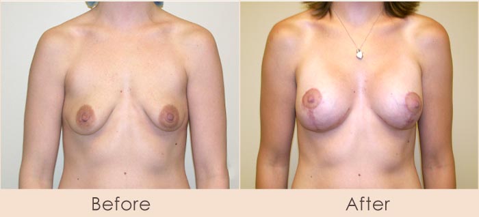 Breast Lift with Scarless Breast Implants, 175cc – 215cc Under Muscle