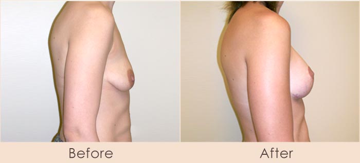Breast Lift with Scarless Breast Implants, 175cc – 215cc Under Muscle