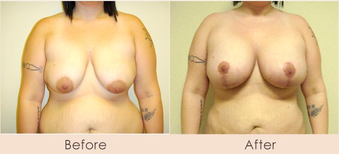 Breast Lift with Scarless Breast Implants, 425cc – 500cc Under Muscle
