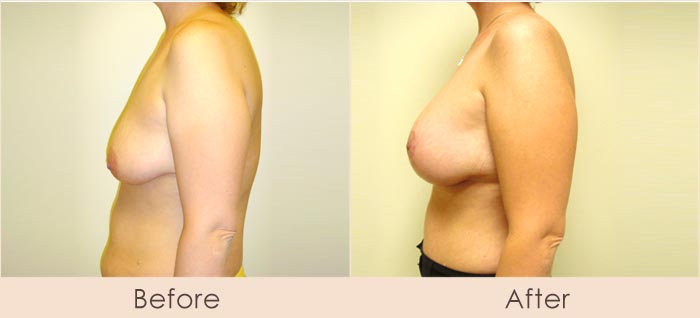 Breast Lift with Scarless Breast Implants, 325cc – 400cc Under Muscle