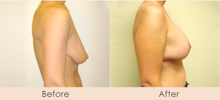 Breast Lift with Scarless Breast Implants, 325cc – 400cc Under Muscle