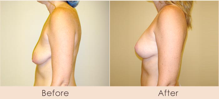 Breast Lift with Scarless Breast Implants, 250cc – 290cc Under Muscle
