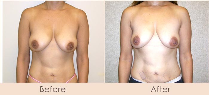 Scarless Breast Reduction Surgery