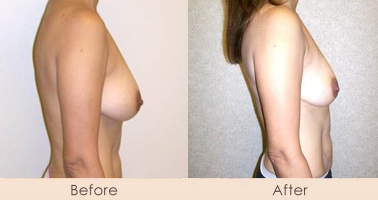Scarless Breast Reduction Surgery