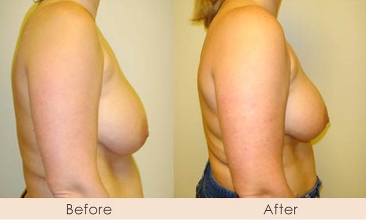 Scarless Breast Reduction Surgery Gallery