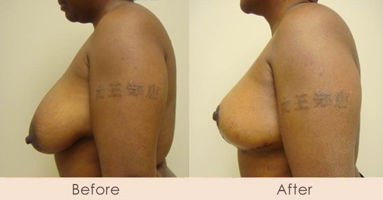 Traditional Breast Reduction 5 Days Post Surgery
