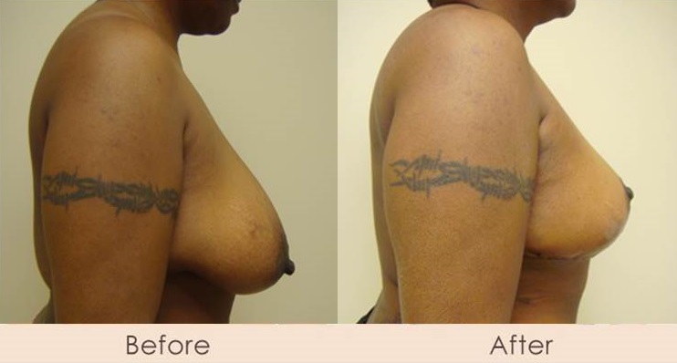 Traditional Breast Reduction 5 Days Post Surgery
