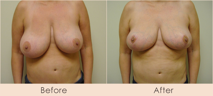 Traditional Breast Reduction