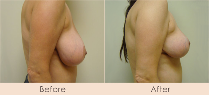 Traditional Breast Reduction