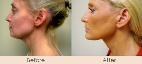 Chin Implant & Face Lift