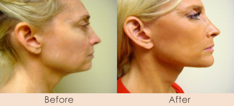Chin Implant & Face Lift