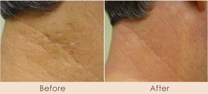 CO2 Repair of the Neck For Acne Scarring