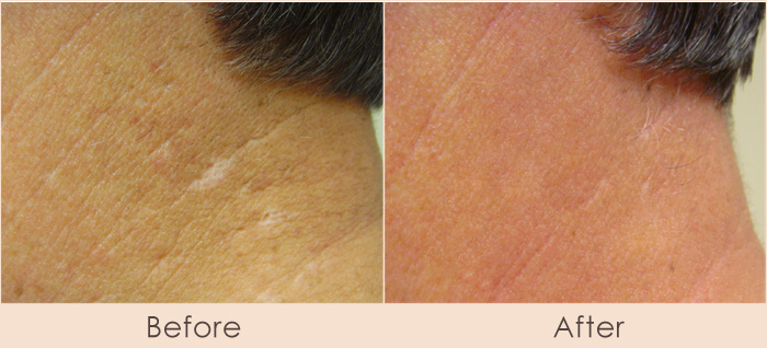 CO2 Repair of the Neck For Acne Scarring