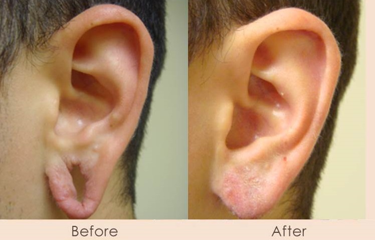 Ear Lobe Repair