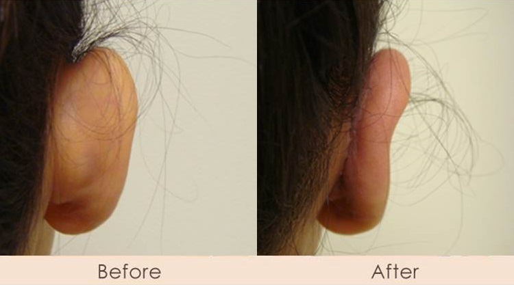 Ear Reconstruction – Otoplasty
