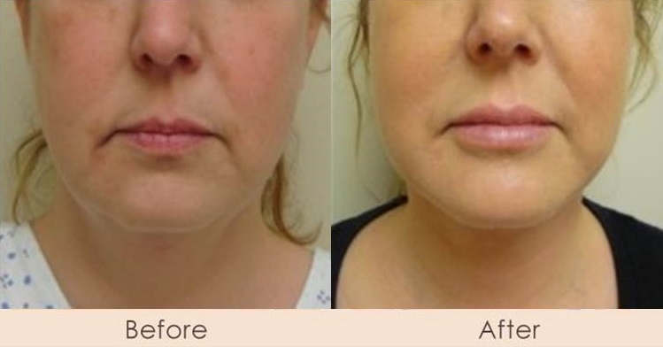 Face Lift & Chin Implant