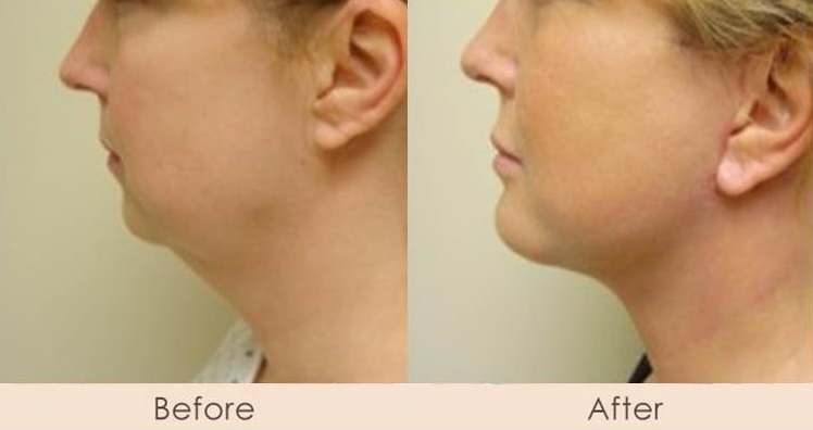 Face Lift & Chin Implant