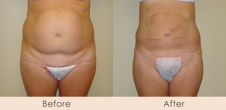 External Ultrasonic Liposuction of Abdomen